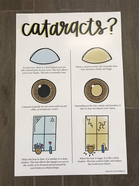 Cataract Poster Cataract Educational Poster Optometry Wall - Etsy Canada