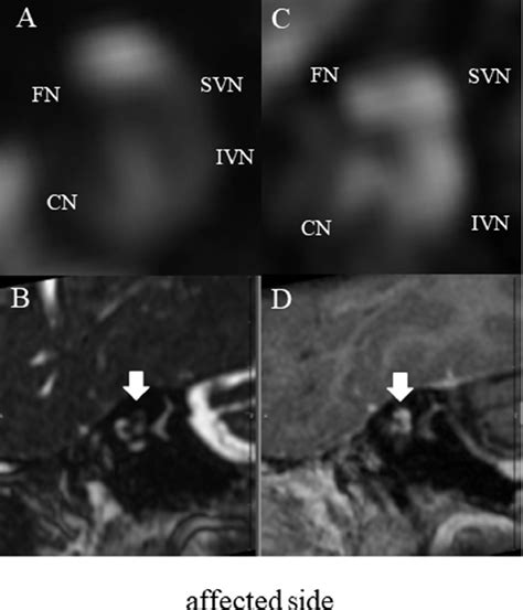 Ramsay Hunt Syndrome Radiology Ramsay Hunt Syndrome Associated With Spinal Trigeminal Nucleus