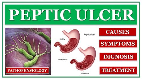 Pathophysiology Of Peptic Ulcer