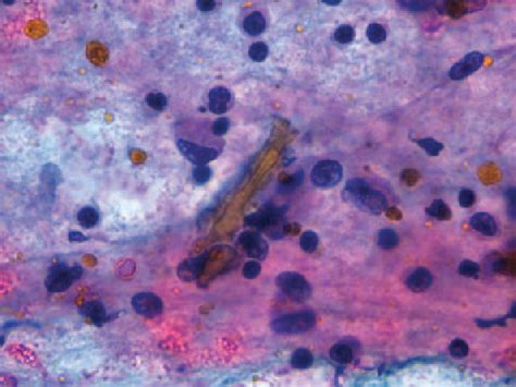 Figure 3 From Gamna Gandy Bodies From Cardiac Myxoma On Intraoperative