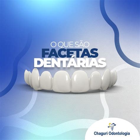 O QUE SÃO FACETAS DENTÁRIAS Chaguri Odontologia