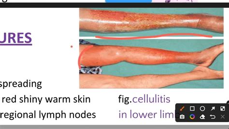 Cellulitis Upper Leg