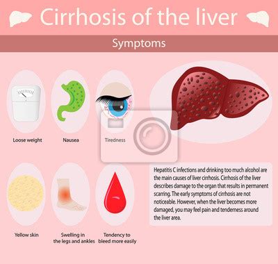 Symptoms Of Cirrhosis Oh The Liver Vector Illustration Wall Stickers