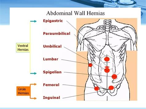 ventral hernia  dr teo