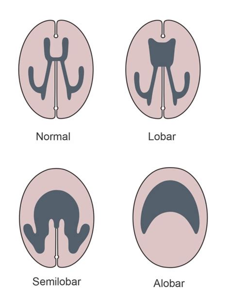 Figure 5 Types Of Holoprosencephaly Endotext NCBI Bookshelf