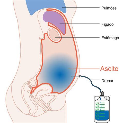 O Que É Ascite Na Barriga - Ascite
