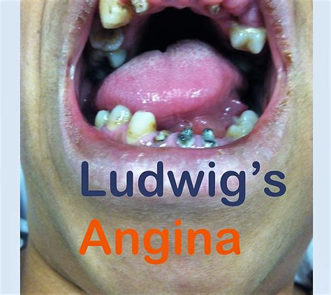 Ludwig’s Angina- more than a toothache