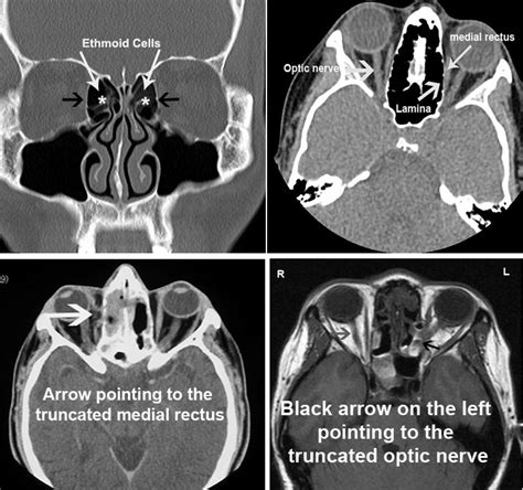 Endoscopic Sinus Surgery Dr Dharambir S Sethi