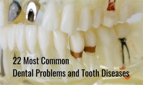 Most Common Dental Problems And Common Tooth Diseases