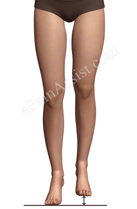 Iliotibial Band Syndrome or Runners Knee: Symptoms, Causes, Treatment