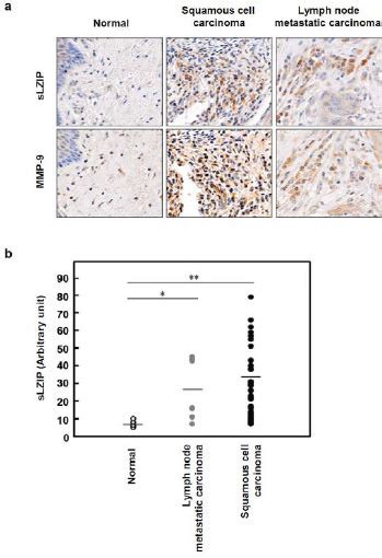 Expressions Of Slzip And Mmp Are Elevated In Cervical Tumors A The