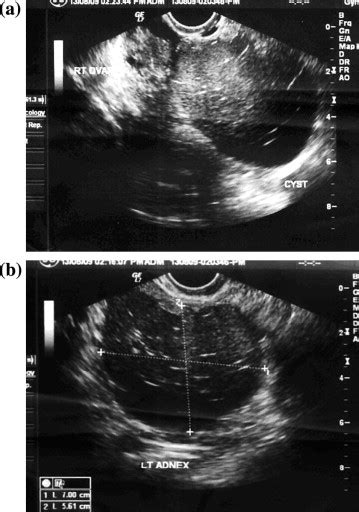 Dermoid Ovarian Cyst Ultrasound