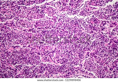 Histopathology Interstitial Pneumonia Light Micrograph Photo Stock