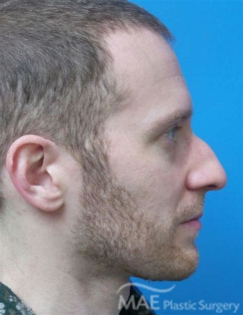 How To Sleep Safely After Rhinoplasty Mae Plastic Surgery