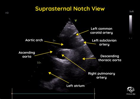 Suprasternal Notch Echo