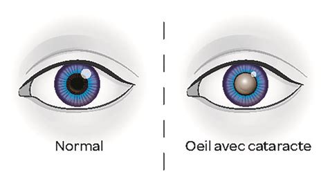 Tout savoir sur la cataracte C bon à savoir