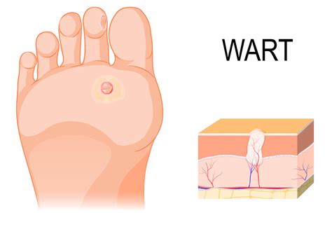 Plantar Warts Corrigan Podiatry