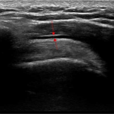 -Grayscale ultrasound image of the left shoulder: red arrows ...