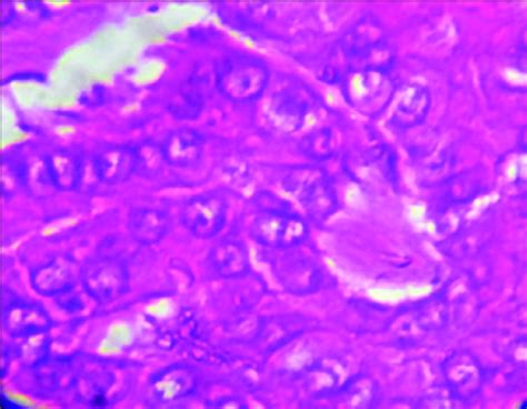 Papillary carcinoma of the thyroid. The microscopic appearance of a... | Download Scientific Diagram