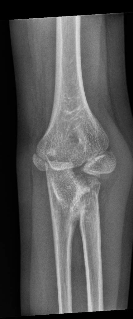 Proximal Radioulnar Joint