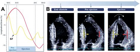 Echocardiographic Patterns Of Abnormal Septal Motion Beyond Myocardial