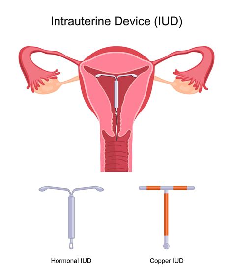 Intra Uterine Device (IUD) Singapore - EZRA Clinic