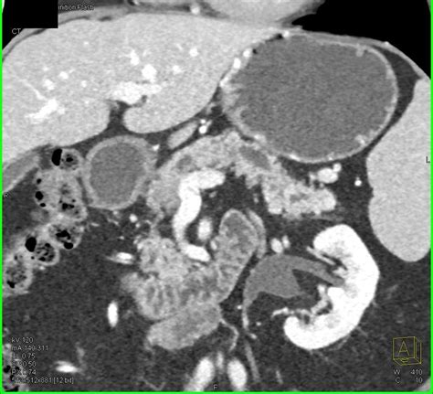 Pancreatic Cancer With Dilated Pancreatic Duct And Incidental Gist