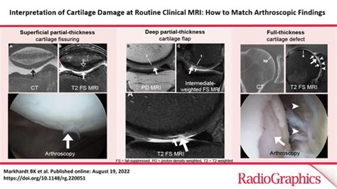 Interpretation Of Cartilage Damage At Routine Clinical MRI How To