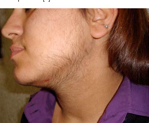 Figure 2 From Laser Diodo 800nm And Hirsutism In Darker Skinned Patients Our Experience On 552