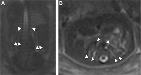 Mr Imaging Of The Fetal Genitourinary Tract Magnetic Resonance Imaging Clinics