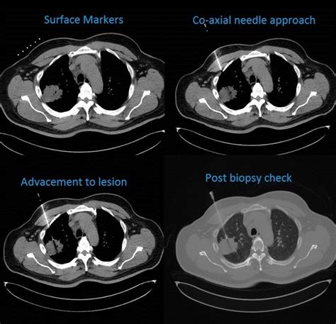 CT guided thoracic biopsy | pacs