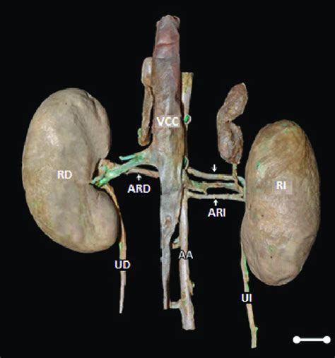 Macrofotograf A Mostrando La Arteria Renal Izquierda Doble En C Thous