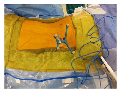 Intraoperative Images Of The Percutaneously Placed Reference Pin And