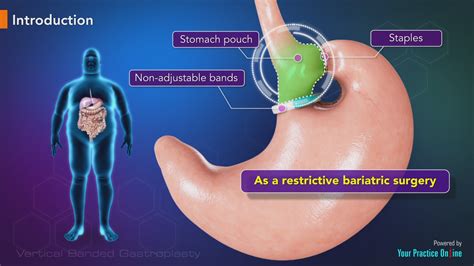 Vertical Banded Gastroplasty Surgery Video | Stomach Stapling Surgery