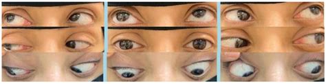 American Journal Of Case Reports Brown Syndrome From Local Anesthesia For Inferior Orbital Fat