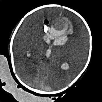 An axial view of the brain on CT scan showing the giant aneurysm and an ...