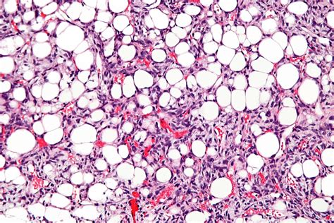 Liposarcoma Pathophysiology Wikidoc