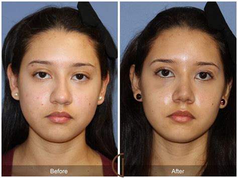 How Long Does Bruising Last After Rhinoplasty