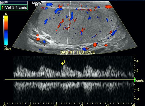 Pathology Outlines Torsion