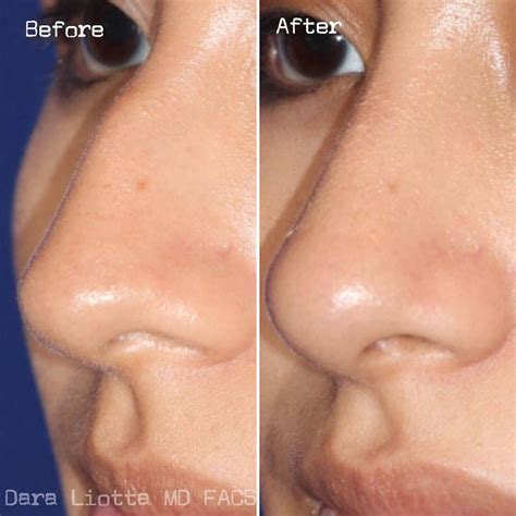 Rhinoplasty Archives Dr Dara Liotta