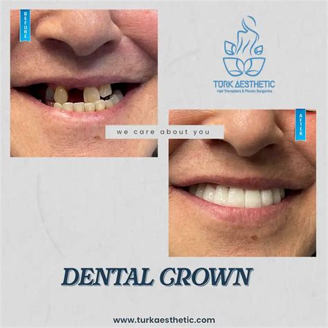 Zirconium Crowns In Turkey Days Turk Aesthetic