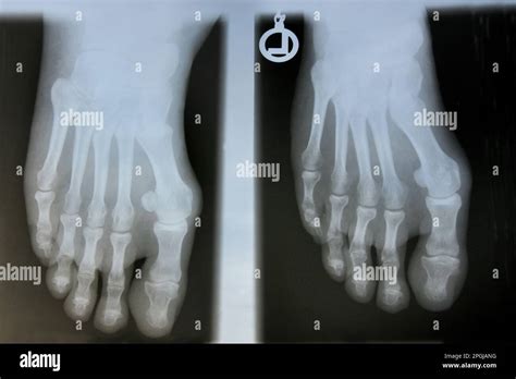 Hallux Valgus X Rays Before Surgery Stock Photo Alamy