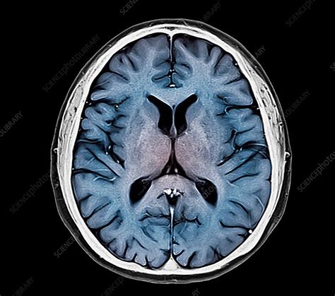 Human brain, basal ganglia, MRI scan - Stock Image - C036/6925 ...