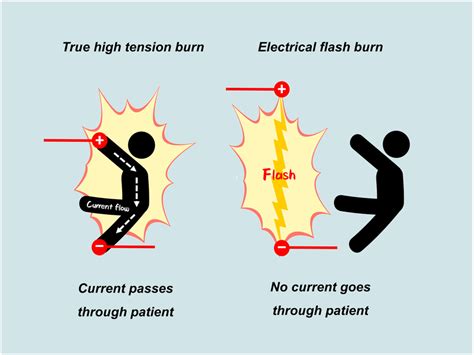 Distinction Between True High‐tension Burn And Electrical Flash Burn