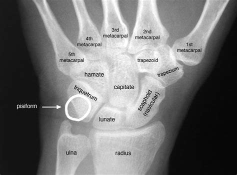 Intersection Syndrome Sport Med School