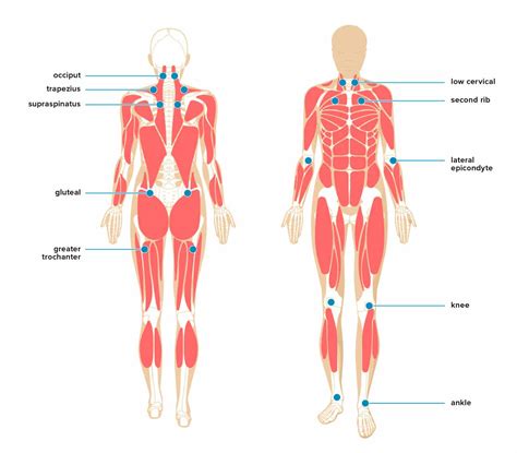 Myofascial Pain Syndrome - NJ Spine and Pain Institute