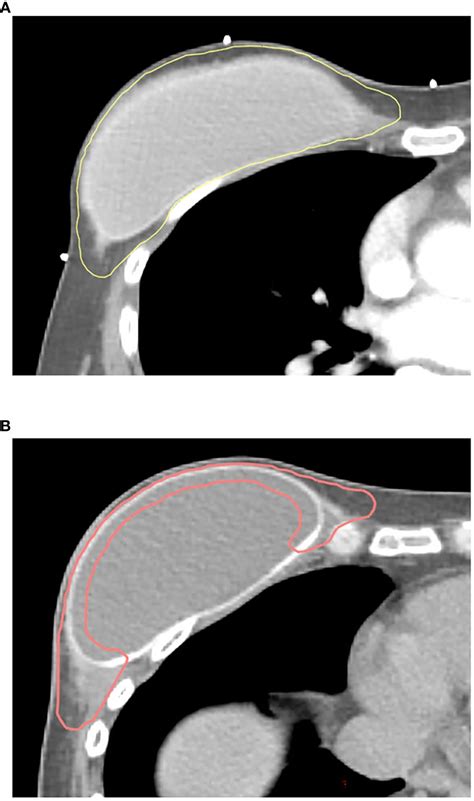 Frontiers The Impact Of The New Estro Acrop Target Volume Delineation