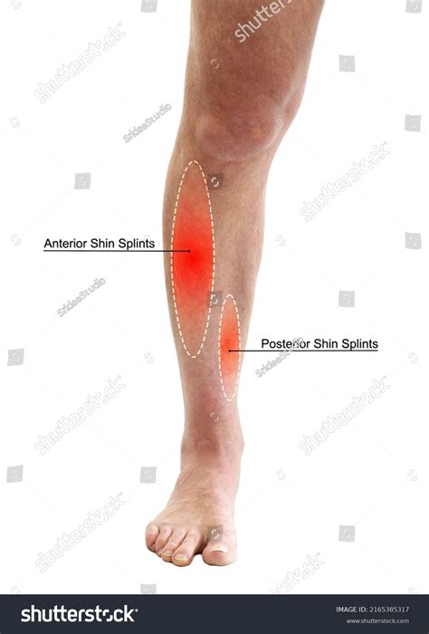 leg pain shin splints  brianna hort blog
