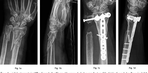 Figure From Initial Shortening And Internal Fixation In Combination