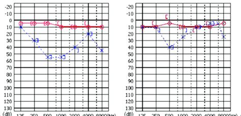 Audiogram Showing An Improvement In Hearing Loss A A Pure Tone